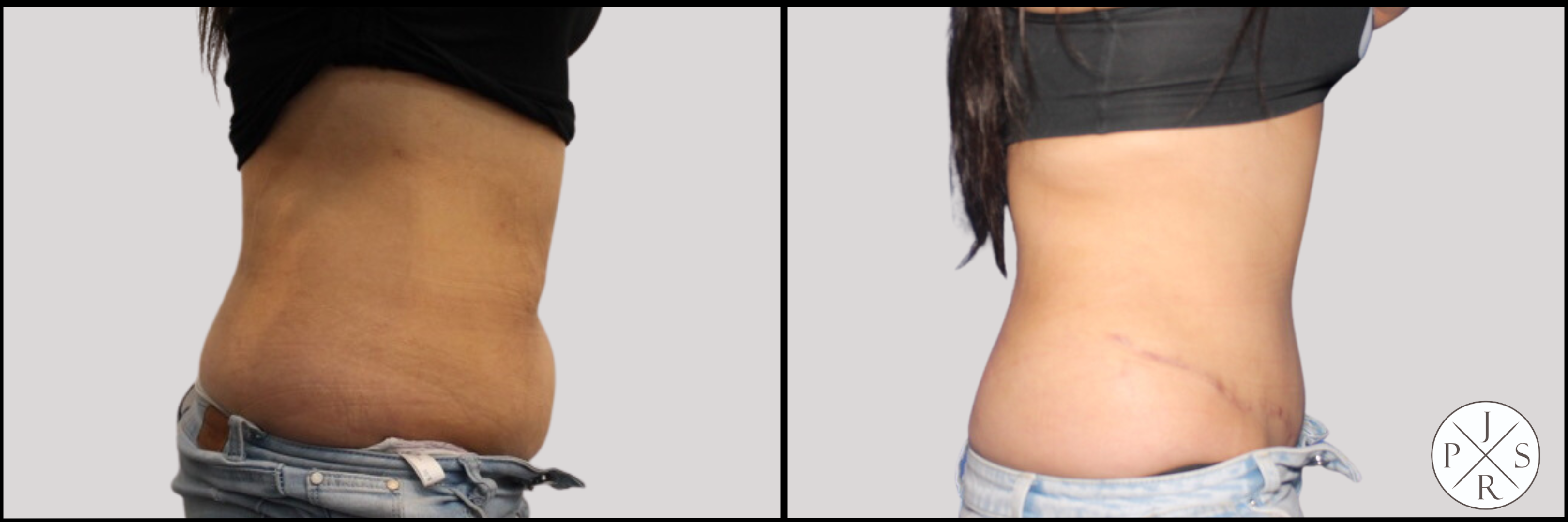 Abdominoplasty Before & After Image